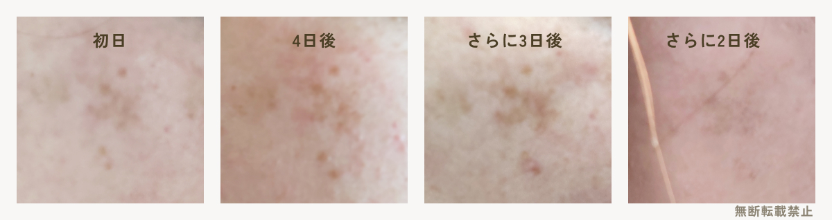 旭研究所業務用ハイドロキノン10gを使っている経過写真